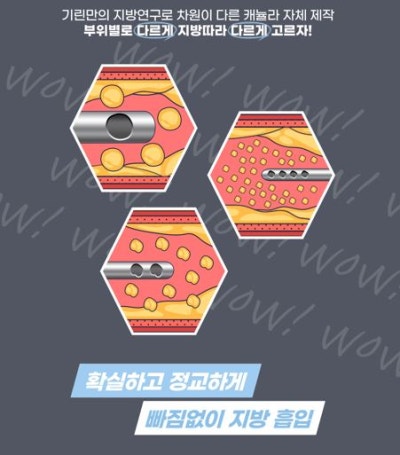 [기린성형외과]팔뚝지방흡입_나도뼈팔될수있을까 사진 17