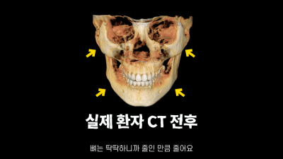 [기린성형외과]성형해도 답 없는 얼굴 _긴얼굴편 사진 7