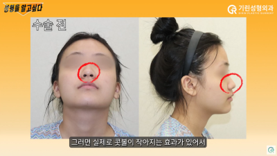 [기린성형외과] "콧볼축소하면 숨 쉬기 힘들어져요?"_콧볼축소 수술의 모든 것