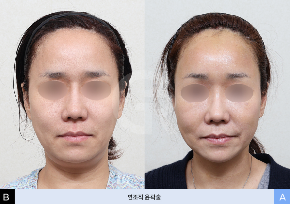 연조직윤곽술이란? 얼굴이 커 보이는 이유, 꼭 뼈 때문만은 아닙니다 사진 3