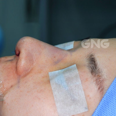 비중격만곡증수술후기, 병원 선택할 때 이런 경우 피하세요 사진 2