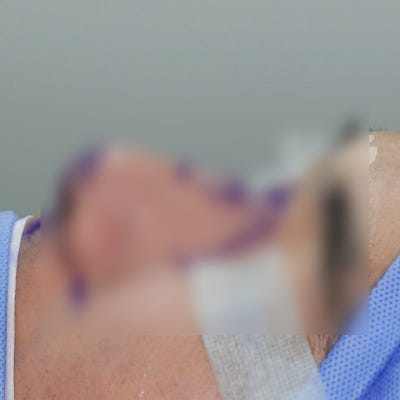 코막힘수술, 꼭 물어봐야 할 5가지 질문