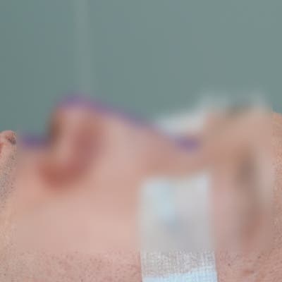 코수술회복기간, 3일째 이런 증상은 위험신호입니다