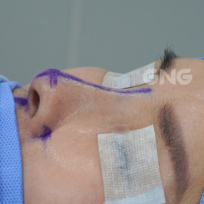 코재수술성형외과, 상담 시 이것만은 꼭 물어보세요
