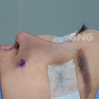 코재수술성형외과, 상담 시 이것만은 꼭 물어보세요 사진 2