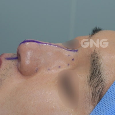 비중격만곡증수술후기, 3개월 뒤 재발한 사례 분석