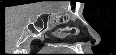 비골골절, 후유증 없는 치료하려면 사진 5