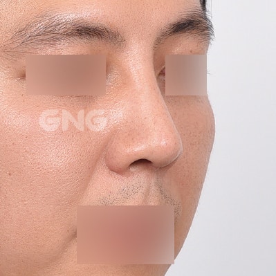 비염수술코성형 비용부터 과정까지 총정리 사진 5