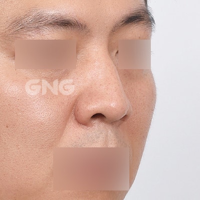 비염수술코성형 비용부터 과정까지 총정리 사진 4