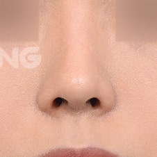무보형물코성형 비용, 보형물 수술과의 차이 사진 5