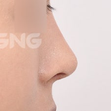 무보형물코성형 비용, 보형물 수술과의 차이 사진 6