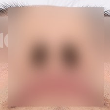 늑연골코수술 비용은? 자가조직의 장점 사진 4