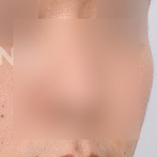 늑연골코수술 비용은? 자가조직의 장점 사진 3