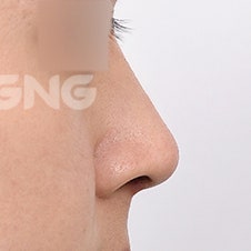 늑연골코수술 비용은? 자가조직의 장점 사진 8