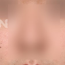늑연골코수술 비용은? 자가조직의 장점