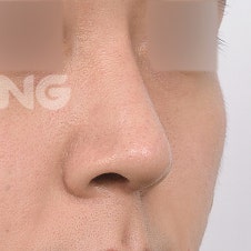 늑연골코수술 비용은? 자가조직의 장점 사진 6