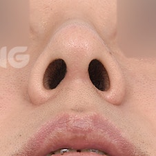 늑연골코수술 비용은? 자가조직의 장점 사진 7