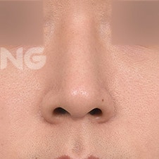 늑연골코수술 비용은? 자가조직의 장점 사진 2