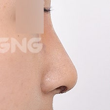 무보형물코성형 비용과 수술 방법 상세 가이드 사진 10