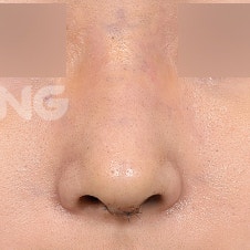 무보형물코성형 비용과 수술 방법 상세 가이드 사진 9