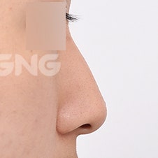 무보형물코성형 비용과 수술 방법 상세 가이드 사진 6