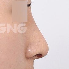 무보형물코성형 비용과 수술 방법 상세 가이드 사진 8