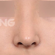 무보형물코성형 비용과 수술 방법 상세 가이드 사진 7