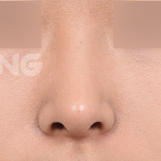 무보형물코성형 비용과 수술 방법 상세 가이드 사진 11