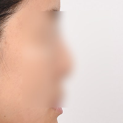자가늑코수술 비용과 선택 기준은? 사진 6