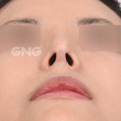 자가늑코수술 비용과 선택 기준은? 사진 7