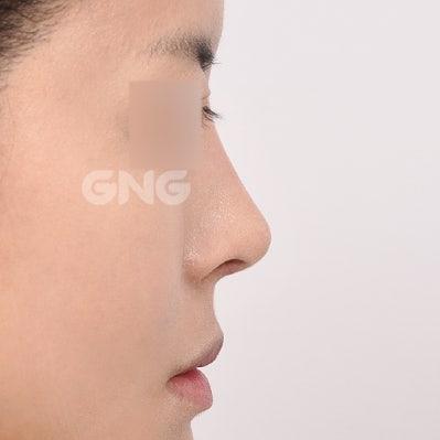 자가늑코수술 비용과 선택 기준은? 사진 9