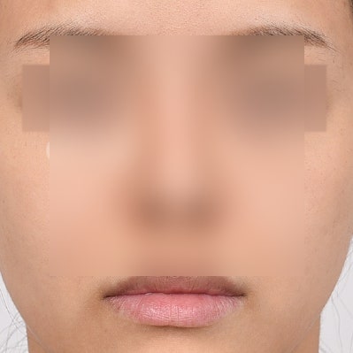 자가늑코수술 비용과 선택 기준은? 사진 5