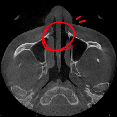 비중격만곡증수술후기, 보험 적용 받은 과정 사진 7