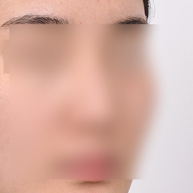 매부리코교정 수술 방법, 절개 vs 노플란트 코연골주사 사진 4