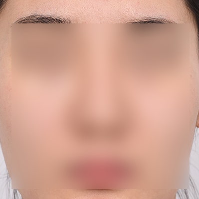 매부리코교정 수술 방법, 절개 vs 노플란트 코연골주사 사진 5