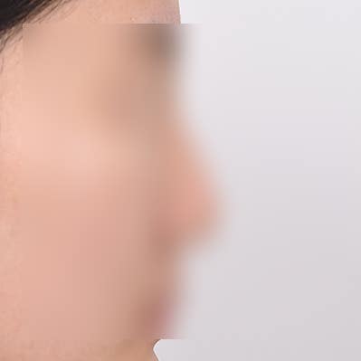매부리코교정 수술 방법, 절개 vs 노플란트 코연골주사 사진 6