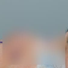 코재수술비용 병원별 차이 비교분석 사진 4