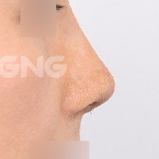 코재수술비용 병원별 차이 비교분석 사진 8
