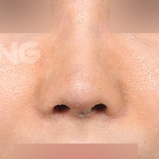 코재수술비용 병원별 차이 비교분석 사진 7