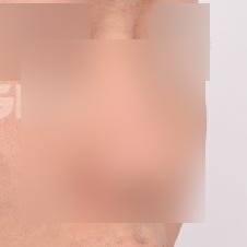 비절개코수술 vs 절개코수술, 나에게 맞는 건?