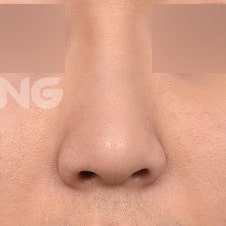 비절개코수술 vs 절개코수술, 나에게 맞는 건? 사진 6