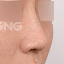 비절개코수술 vs 절개코수술, 나에게 맞는 건? 사진 8