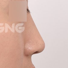 비절개코수술 vs 절개코수술, 나에게 맞는 건? 사진 10