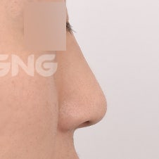 비절개코수술 vs 절개코수술, 나에게 맞는 건? 사진 7