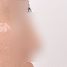 비절개코수술 vs 절개코수술, 나에게 맞는 건? 사진 3