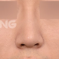비절개코수술 vs 절개코수술, 나에게 맞는 건? 사진 9