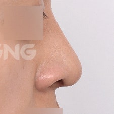 한쪽코막힘 원인과 해결법 3가지 사진 7