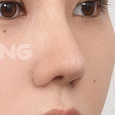 코끝성형 비용, 합리적인 가격대는 얼마? 사진 6