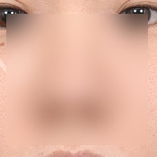 코끝성형 비용, 합리적인 가격대는 얼마?