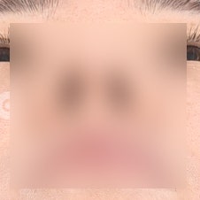 코끝성형 비용, 합리적인 가격대는 얼마? 사진 9
